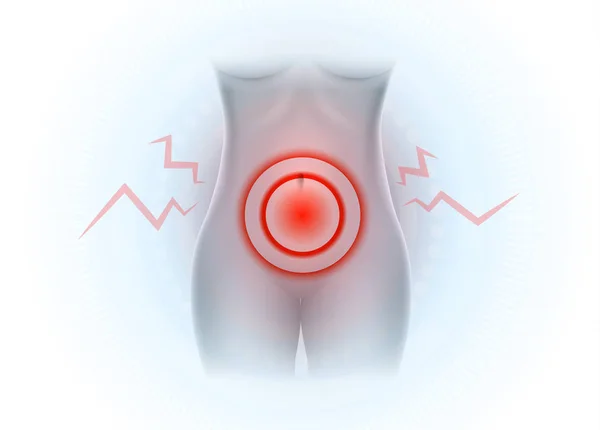 Weibliche Unterbauchschmerzen Beckenschmerzen — Stockvektor