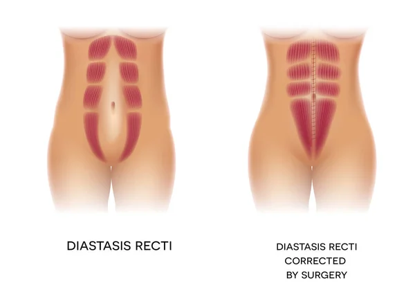 Recti 也称为分离腹直肌或腹部分离 在孕妇和产后是常见的 手术前后矫正 — 图库矢量图片