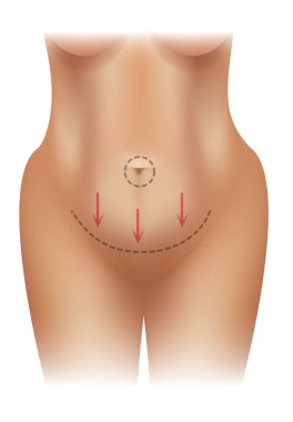 Beyaz bir arka plan üzerinde renkli resimde ameliyatla kadın obez vücut hatları