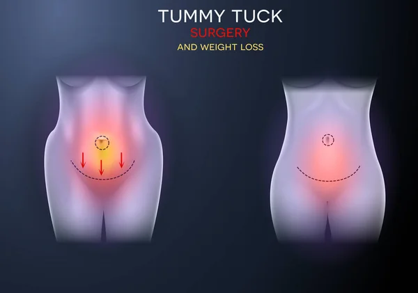 Vrouwelijk Lichaam Correctie Voor Chirurgie Gewicht Verlies Kleurrijke Illustratie Een — Stockvector