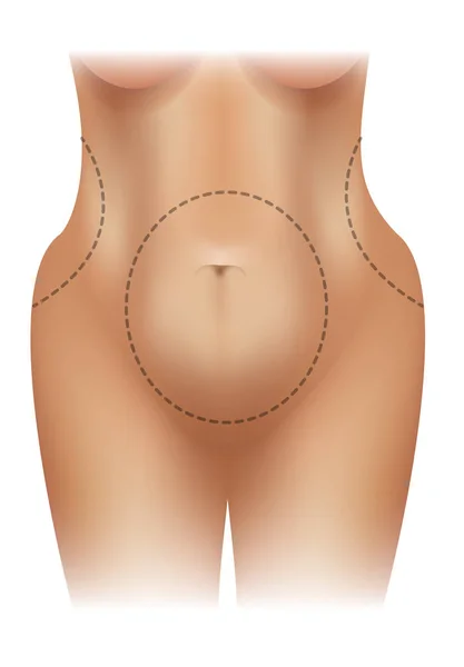 Παχύσαρκα Σώμα Χειρουργική Γραμμές Πολύχρωμη Εικονογράφηση Λευκό Φόντο — Διανυσματικό Αρχείο