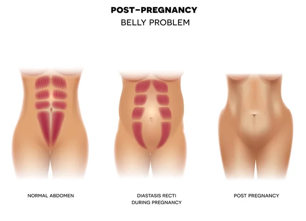 Corps Féminin Avant Grossesse Avec Des Muscles Normaux Diastasis Recti — Image vectorielle