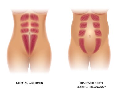 Tabii Recti gebelikte, olarak da bilinen tabii Rektus Abdominus veya karın ayrılık, hamile kadınlar ve sonrası Doğum arasında yaygındır. Kaslar arasında bir boşluk olduğunu.