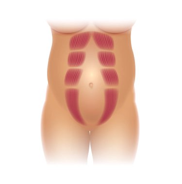 Tabii Recti gebelikte, olarak da bilinen tabii Rektus Abdominus veya karın ayrılık, hamile kadınlar ve sonrası Doğum arasında yaygındır. Kaslar arasında bir boşluk olduğunu.