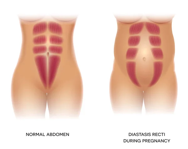 Diastasis Recti Durante Embarazo También Conocida Como Diastasis Rectus Abdominus — Archivo Imágenes Vectoriales