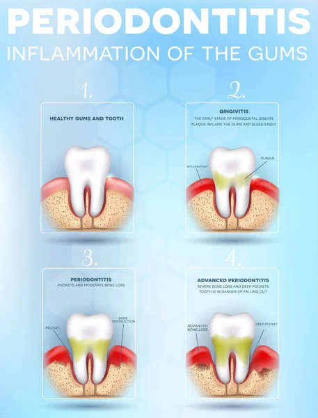 Periodontite Infiammazione Degli Stadi Gengivali Illustrazione Dettagliata Dente Sano Gengivite — Vettoriale Stock