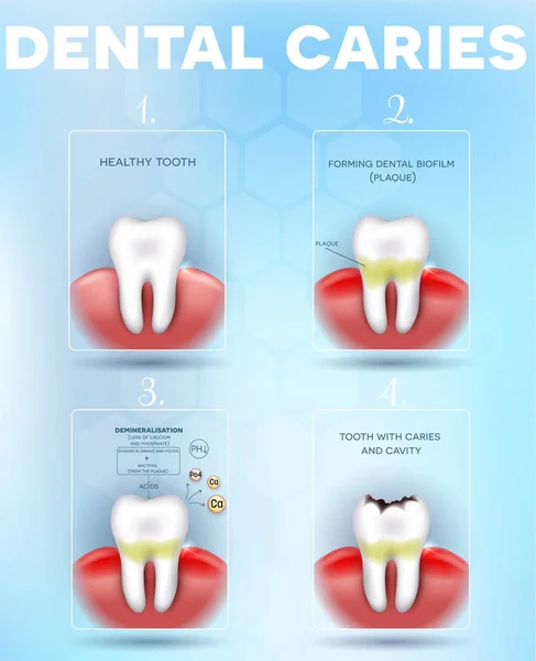 Carie Dentaria Formazione Carie Dentali Diagramma Dettagliato Placca Dentale Perdita — Vettoriale Stock