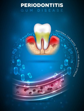 Periodontitis, iltihap diş etleri bakterilerin kan akışı ve felç, diyabet ve kalp hastalığı gibi vücudun diğer bölümlerine başlatmak komplikasyon girebilirsiniz