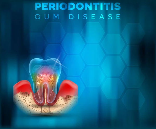 Periodontitis Gum Disease Poster Inflammation Gums Bright Blue Mesh Background — Stock Vector