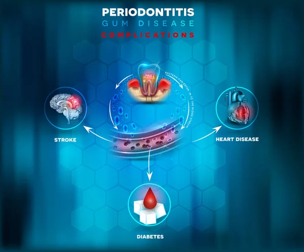 Periodontitis Komplikasyonlar Bakteri Kan Akışına Girin Felç Diyabet Kalp Hastalığı — Stok Vektör