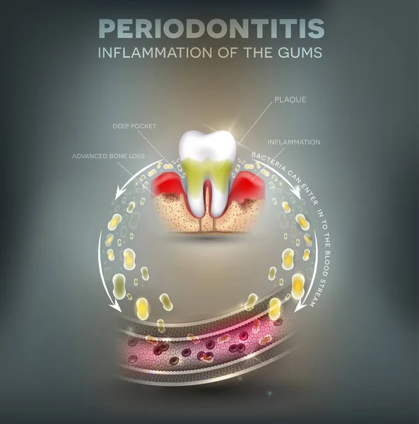 牙周炎 牙龈细菌的炎症会进入血液 并在身体其他部位引发中风 糖尿病和心脏病等并发症 — 图库矢量图片