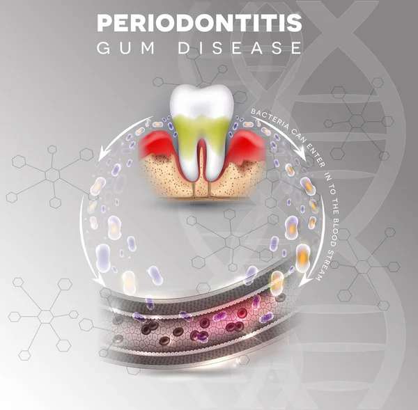 Parodontite Inflammation Des Gencives Bactéries Peuvent Entrer Dans Circulation Sanguine — Image vectorielle