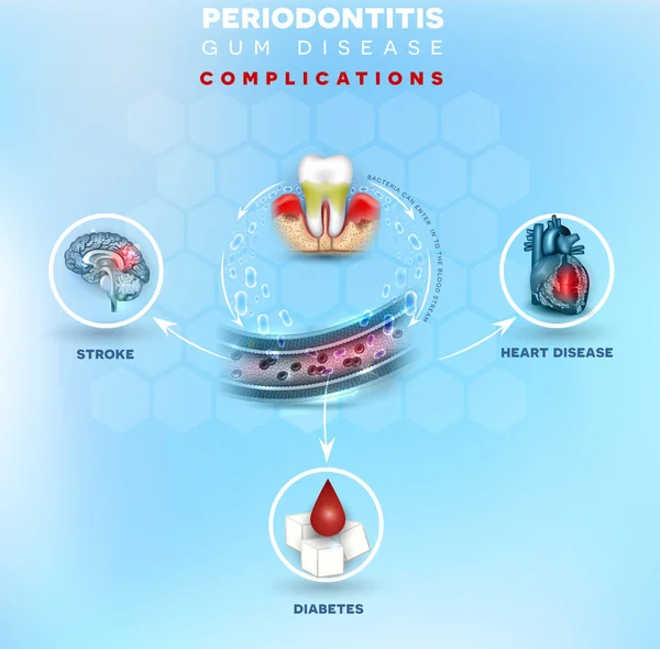 Parodontite Inflammation Des Gencives Bactéries Peuvent Entrer Dans Circulation Sanguine — Image vectorielle