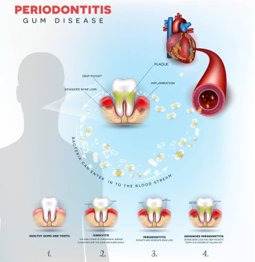 Dişeti hastalığı Periodontitis komplikasyonları. İltihaplı diş etleri bakterilerden kan akışına girin ve kalp gibi diğer organlara etkileyen.