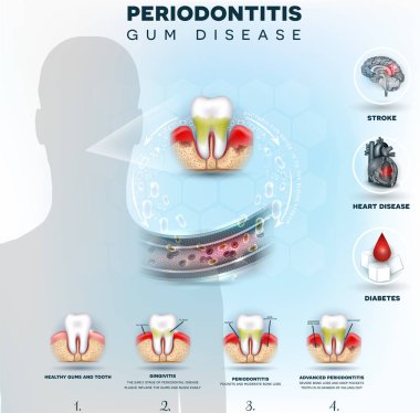 Dişeti hastalığı komplikasyonları, Periodontitis resimde ayrıntılı. İltihaplı diş etleri bakterilerden kan akışına girin ve diğer organlar beyin, kalp gibi etkiler ve şeker hastalığı neden