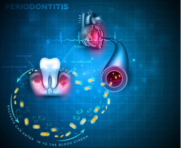 歯周病歯周炎の合併症 炎症を起こして歯茎から細菌が血流に入力し 心臓などの他の臓器に影響を与える — ストックベクタ