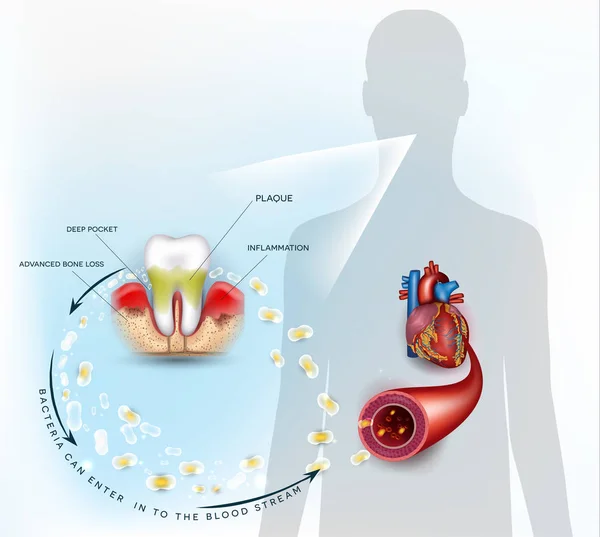 牙龈疾病炎症细菌可进入血液中影响心脏 抽象蓝色背景下的牙周炎解剖 — 图库矢量图片