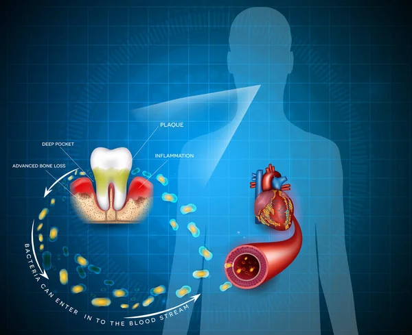 Gum Sjukdom Inflammation Bakterier Kan Komma Att Blodet Påverkar Hjärtat — Stock vektor