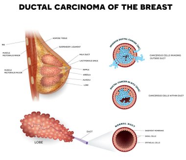 Ductal carcinoma of the breast, detailed medical illustration. Ductal cancer in situ and invasive ductal cancer cross section anatomy on a white background. clipart