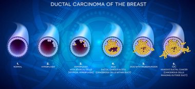 Ductal carcinoma of the breast, detailed medical illustration. At the beginning normal duct, then hyperplasia, after that atypical cells are invading, Ductal cancer in situ and invasive ductal cancer. clipart