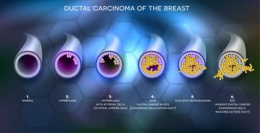 Ductal carcinoma of the breast, detailed medical illustration. At the beginning normal duct, then hyperplasia, after that atypical cells are invading, Ductal cancer in situ and invasive ductal cancer. clipart