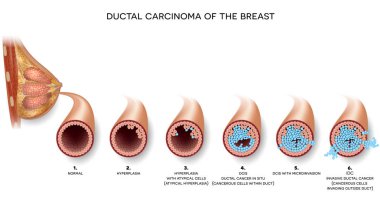 Ductal carcinoma of the breast cross section anatomy, detailed anatomy illustration. At the beginning normal duct, then hyperplasia, after that atypical cells are invading. clipart