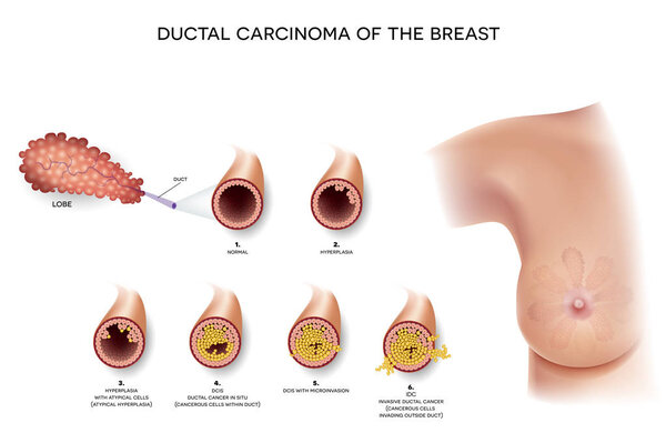 Ductal carcinoma of the breast, detailed medical illustration. At the beginning normal duct, then hyperplasia, after that atypical cells are invading, Ductal cancer in situ and invasive ductal cancer.