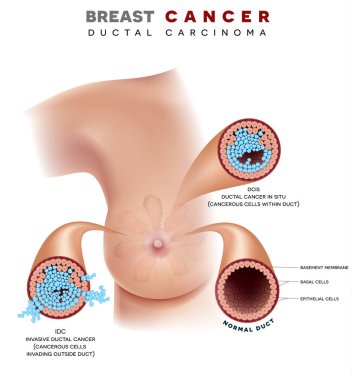 Breast cancer Ductal carcinoma of the breast, detailed medical illustration. Normal duct, Ductal cancer in situ and invasive ductal cancer with metastases clipart