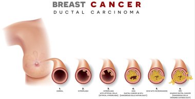 Breast cancer Ductal carcinoma of the breast, detailed medical illustration. At the beginning normal duct, then hyperplasia, after that atypical cells are invading, Ductal cancer in situ and invasive ductal cancer. clipart