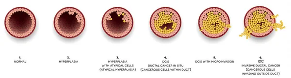 상세한 일러스트 Ductal 증식에서 비정형 침입은 Ductal 제자리 Ductal — 스톡 벡터