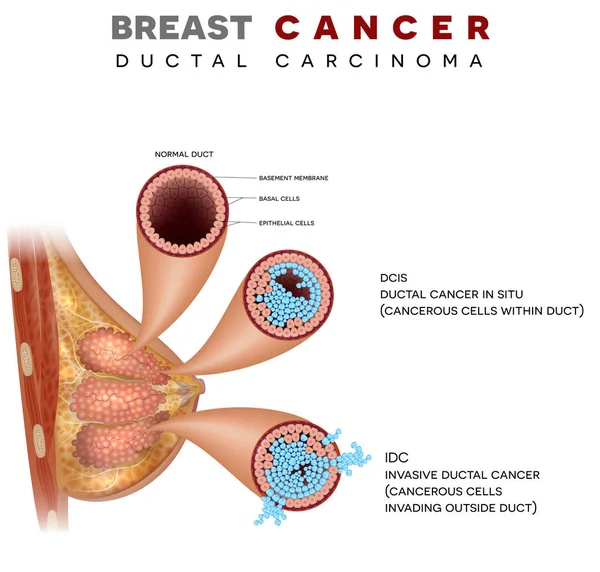 Illustration Anatomie Cancer Sein Carcinome Ductal Sein Illustration Médicale Détaillée — Image vectorielle
