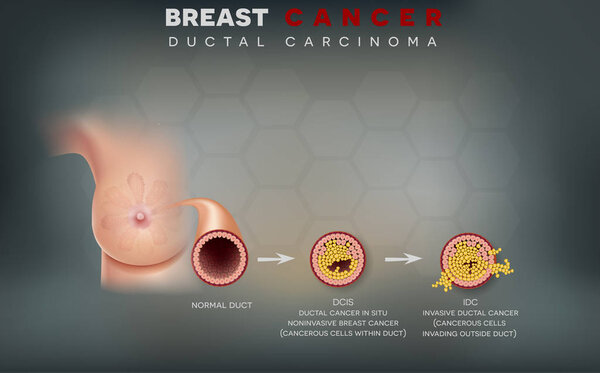 Breast cancer anatomy illustration, Ductal carcinoma of the breast, detailed medical illustration. Normal duct, Ductal cancer in situ and invasive ductal cancer.