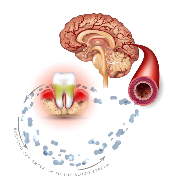 Teeth Problems Complications Gum Disease Inflammation Bacteria Can Enter Blood — Stock Vector