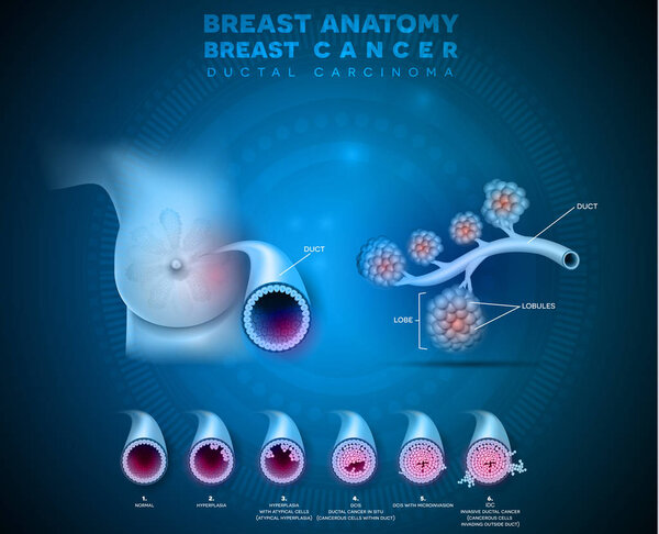 Breast cancer anatomy illustration, Ductal carcinoma of the breast, detailed medical illustration. Normal duct anatomy, Ductal cancer in situ and invasive ductal cancer 
