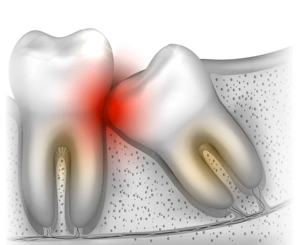 Problemi Eruzione Dei Denti Della Saggezza Anatomia Illustrata — Vettoriale Stock