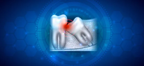 Προβλήματα Έκρηξη Των Δοντιών Σοφία Εικονογραφημένη Ανατομία Ένα Αφηρημένο Μπλε — Διανυσματικό Αρχείο