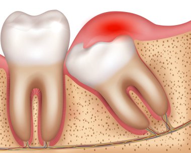 Yirmilik diş Erüpsiyonu sorunları iltihaplı diş etleri resimli anatomi