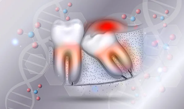 Weisheitszahn Ausbruch Entzündete Zahnfleisch Veranschaulicht Anatomie Auf Einem Schönen Abstrakten — Stockvektor