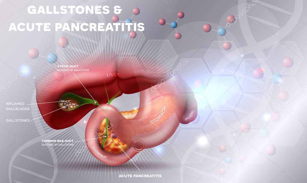 Gallstones and Pancreatitis