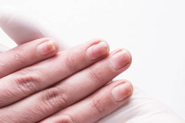 Onycholysis Geïsoleerd Een Witte Achtergrond Mechanische Beschadiging Van Nagelplaat Schade — Stockfoto