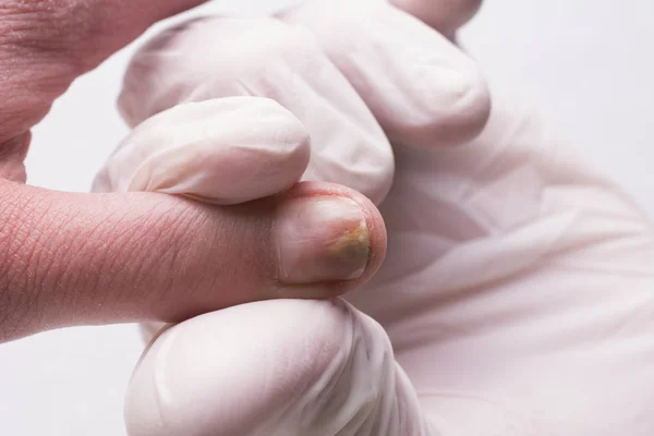 Onicolisis Aislada Sobre Fondo Blanco Daño Mecánico Placa Clavos Daño — Foto de Stock