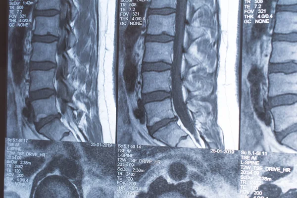 Magnetic resonance tomography (MRT) of the lumbar spine. Hernia