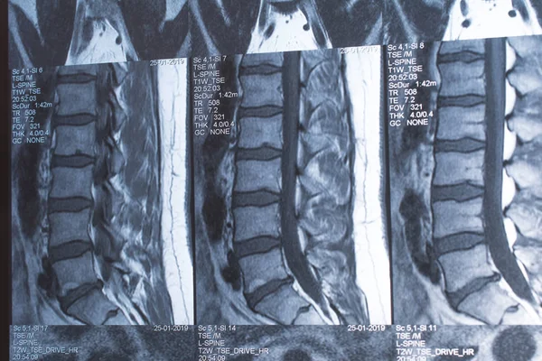 Magnetic resonance tomography (MRT) of the lumbar spine. Hernia