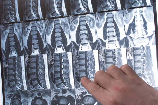 Ręka doktora pokazuje coś na temat wyników MRI (rezonans magnetyczny t — Zdjęcie stockowe