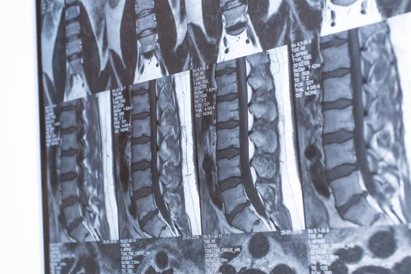 Magnetresonanztomographie (mrt) der Lendenwirbelsäule. Bruch — Stockfoto