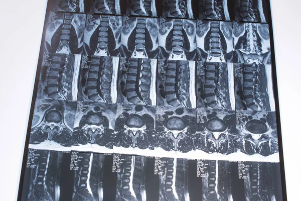 Magnetic resonance tomography (MRT) of the lumbar spine. Hernia