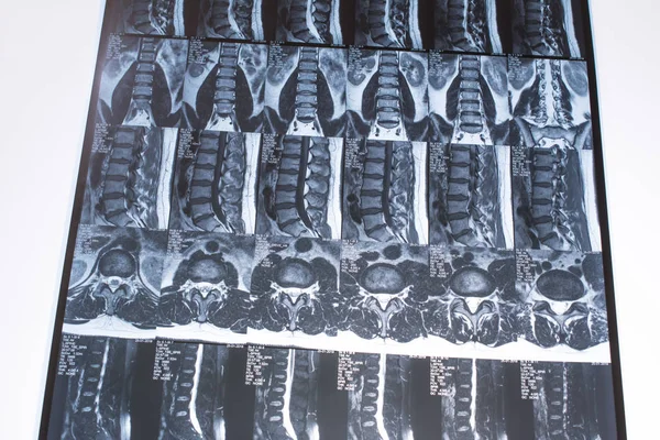 Magnetic resonance tomography (MRT) of the lumbar spine. Hernia