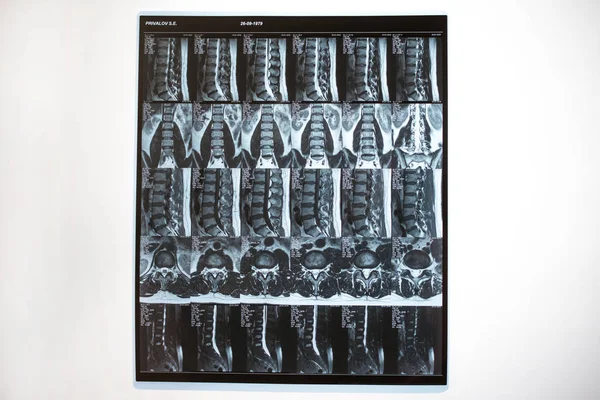 Magnetic resonance tomography (MRT) of the lumbar spine. Hernia