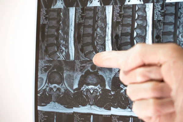 Ręka doktora pokazuje coś na temat wyników MRI (rezonans magnetyczny t — Zdjęcie stockowe