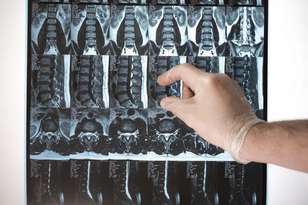 Arzt Hand zeigt etwas auf mri Ergebnisse (Magnetresonanztomographie t — Stockfoto